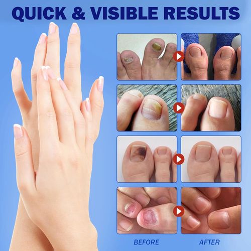 Fungal Nail Patches for Toenails, 21 Count - Nail Repair Patches with 8-Hour Adhesion, for Discolored & Damaged Toenails Care, Overnight Renewal for Men & Women