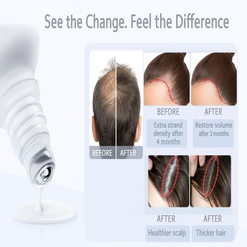 Be Bodywise Rosemary Hair Growth Roll-On Serum contains 3% rosemary, 3% redensy, and 2% anagain. This DHT-inhibiting scalp serum promotes oxygen delivery and reduces hair loss. Paraben-free and suitable for both men and women.