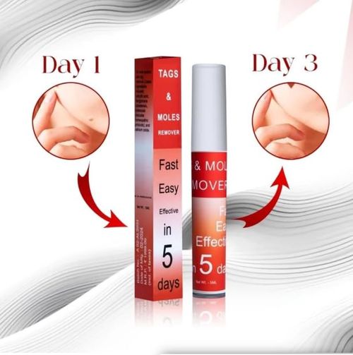 New Arrival  Tags & Moles Remover