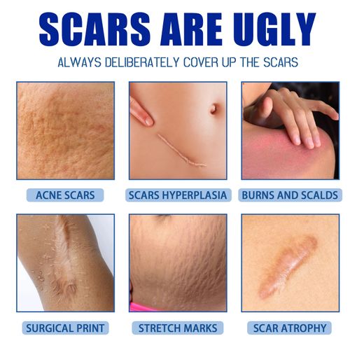 Scar Treatment Skin Care Cream Smooth Surgery Hyperplasia Scars Removal Stretch Marks Burns Repair Body Damaged Skin Gel Serum