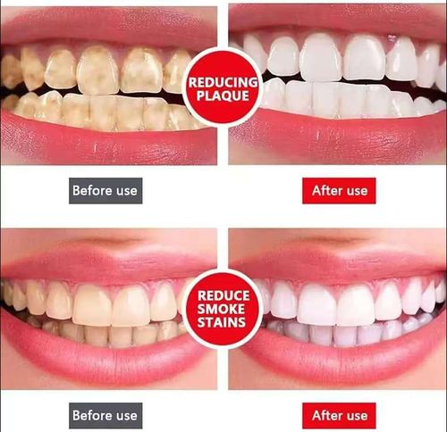 Pasta de dentes clareadora, remove amarelamento e manchas