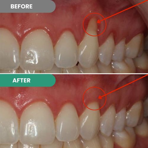 are you struggling with gum recession? a new formula is helping thousands of people to naturally support their gums