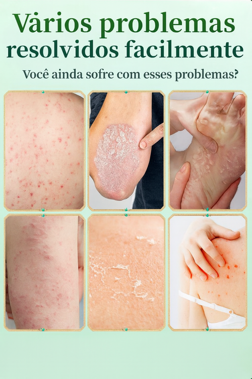 Pomada Antifúngica Rei dos Fungos Adeus Coceira, Feridas e Mau Odor nos Pés 🦶🔥