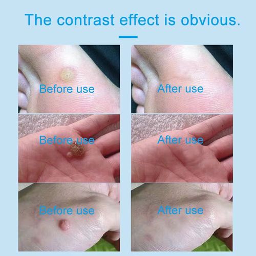 Suitable for various skin warts, Patent formula Ketrodil solution, featuring natural plant extracts, specifically targets flat warts, wart-like growths, and flesh-like horn-like warts. It penetrates deep into the wart base, reducing hyperplasia and improving the skin texture, with a gentle and non-irritating effect. Order today and get 3 bottles, Eliminate warts on the face, hands, and private areas completely, avoiding laser freezing. Enjoy smooth skin at home.