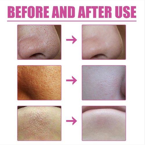 If you place an order today, we will send you a total of 8 bottles (4 bottles of nose strips + 4 bottles of toner) along with an additional 120 pieces of blackhead paper, the aloe vera blackhead removal set. It is a natural formula that gently softens and absorbs, removing blackhead oil within 10 minutes. It's easy to clean at home, leaving pores clean and not red, suitable even for sensitive skin!