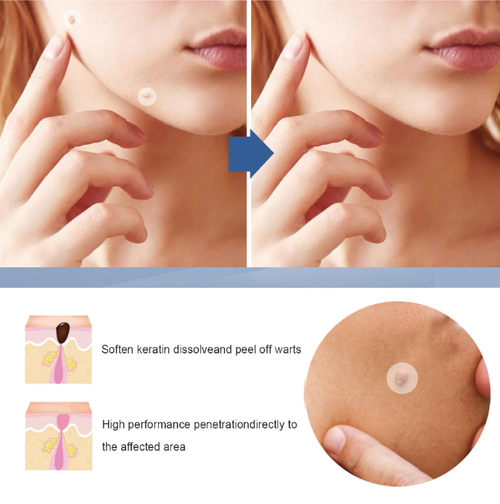 Verruca Removal Patches for Genital Warts and Other Verrucous Lesions. The patches contain vitamin E + tea tree oil. Once applied, they become invisible. Within 7-14 days, the skin tags will naturally fall off. It is non-invasive, painless and does not damage the skin.144 patches in a large package. Place an order today and you will receive 2 boxes upon delivery. It is sufficient for home use. There will be no scars after application. The skin will be smooth and comfortable!