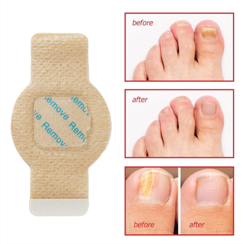 If you place an order today, you will receive 4 packs totaling 84 anti-fungal nail-fungus protection patches. This is enough to cover your nails for half a year. The anti-fungal formula helps inhibit bacteria and protect brittle nails, improving the layering of yellow nails. Just apply one patch before going to bed and you won't need to apply any medication. It relieves pain in the nail groove and improves nail quality.