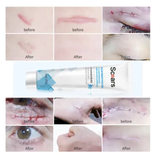 If you place an order today, you will receive 5 boxes of Jiugutang Herbal Scar Repair, Anti-Bacterial and Anti-Scarring Gel. This scar repair gel is designed to treat various types of scars. The extracts of licorice root and onion help to inhibit the growth of scars, while small molecule peptides help to promote healing and make the skin softer. It can also reduce pigmentation and restore the smooth texture of the skin!