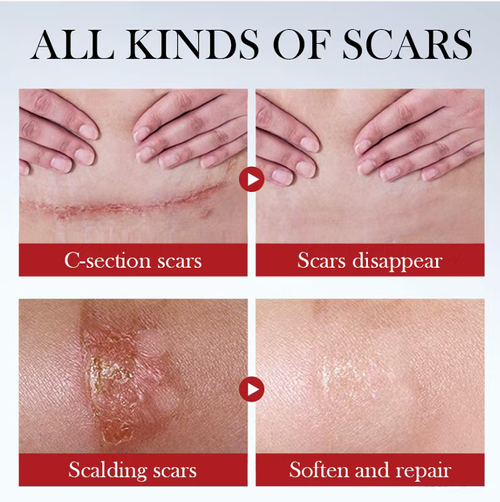 Composite Silicone Scar Cream, specially designed for various types of scars: burn scars, pigmentation scars, new and old acne marks all covered! Silicone + plant extracts penetrate the skin's surface, smoothing out bumps, fading dark spots, refreshing without being greasy, gentle on sensitive skin. Order today and get 6 tubes! Apply twice a day, 70g per tube lasts for two months. Stock up for the whole year, no need to cover scars when wearing revealing outfits.