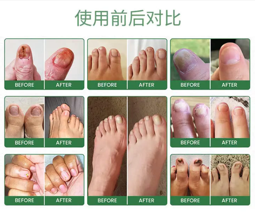 If you place an order today, you will receive 6 units, which is a complete course of treatment. The anti-fungal care pen contains 25% undecenoic acid and precisely penetrates to inhibit fungi. The pen-shaped design is portable and leak-proof, gentle and non-irritating. It can improve chapped feet and athlete's foot. A 2-minute daily care is all you need!