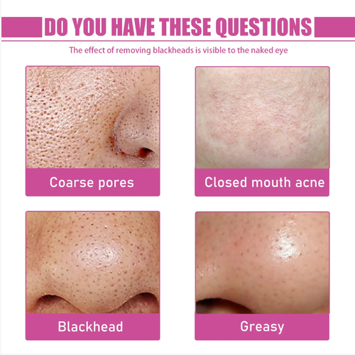 If you place an order today, we will send you a total of 8 bottles (4 bottles of nose strips + 4 bottles of toner) along with an additional 120 pieces of blackhead paper, the aloe vera blackhead removal set. It is a natural formula that gently softens and absorbs, removing blackhead oil within 10 minutes. It's easy to clean at home, leaving pores clean and not red, suitable even for sensitive skin!