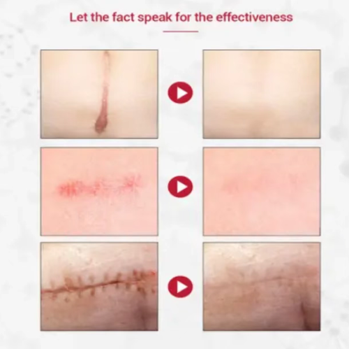 If you place an order today, you will receive 5 boxes of Jiugutang Herbal Scar Repair, Anti-Bacterial and Anti-Scarring Gel. This scar repair gel is designed to treat various types of scars. The extracts of licorice root and onion help to inhibit the growth of scars, while small molecule peptides help to promote healing and make the skin softer. It can also reduce pigmentation and restore the smooth texture of the skin!