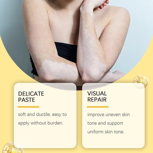 Order today and you'll receive 3 bottles of the anti-leukoplakia herbal extract essence cream. This cream features a blend of herbal extracts and bee venom. It can lighten the spots and even out the skin tone. The cream has a smooth texture that absorbs quickly without leaving a sticky feeling. Even those with sensitive skin can use it. Whether it's localized pigmentation spots or the whitish marks left after sun exposure, you'll start seeing results after using it consistently for two weeks.