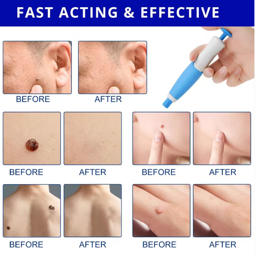 2 Pack Double-Tipped Anti-Virus Pencils,The fine tip is suitable for applying on the corners of the eyes and small warts on the fingers. The wide tip is used for treating warts on the neck, hands and back. The herbal formula is cool and non-irritating. Within 5-7 days, the warts will dry up and fall off without leaving red marks. It is suitable for sensitive skin. You can easily remove the warts at home, showing off your skin with confidence without any concealment!