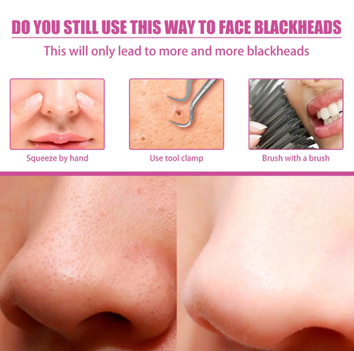 If you place an order today, we will send you a total of 8 bottles (4 bottles of nose strips + 4 bottles of toner) along with an additional 120 pieces of blackhead paper, the aloe vera blackhead removal set. It is a natural formula that gently softens and absorbs, removing blackhead oil within 10 minutes. It's easy to clean at home, leaving pores clean and not red, suitable even for sensitive skin!