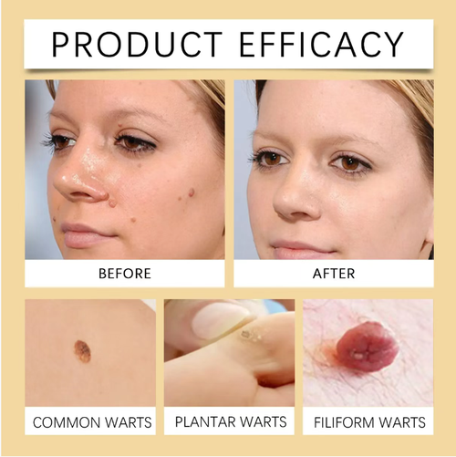 AHCC Mushroom Anti-Virus Rejuvenating Cream, with 4 mushroom formulas, can lighten body wart spots and also relieve skin discomfort in private areas. It can gradually soften rough keratin, and it is suitable for sensitive skin. Order today and get 4 bottles, which is enough for one stage of usage. It has high Value for money. No need for medical treatments,just apply daily,and easily achieve smooth and comfortable skin！