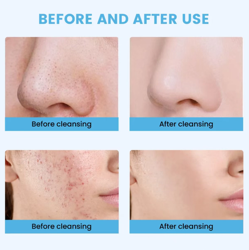 Ultrasonic electric skin scraper with high-frequency vibration to atomize and remove dirt from pores, gently exfoliate blackheads, acne and aged keratin, without damaging the skin barrier. This one device does it all - deep cleansing, exfoliation and brightening the complexion. Say goodbye to strawberry nose and rough skin texture, and double the absorption of skin care products. Compact and portable, you can enjoy professional-level cleaning at home and cultivate a transparent egg-like skin.