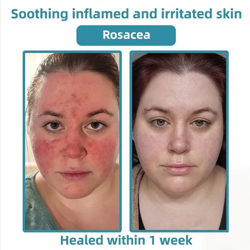 The ultrasonic laser wart removal pen is equipped with 30 years of clinical carbon dioxide laser technology. It can precisely remove moles, warts and skin blemishes, and alleviate the symptoms of rosacea within one week. The pen is small and portable, and can be operated with just one button. It enables you to easily handle various skin blemishes at home, and is gentle and non-irritating to the skin.