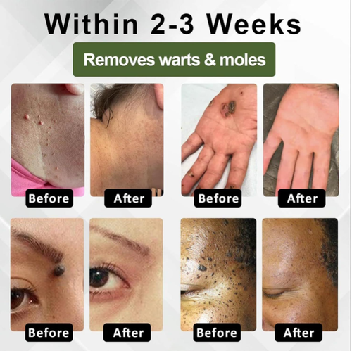 Place your order today and you will receive 3 large bottles of natural gel for removing warts, removing moles and fading spots: avocado + herbal essences. Apply it gently for 2-3 weeks, and the warts will dry up and fall off, while the mole spots will fade to the point of being invisible. Even sensitive skin can use it! Stock up on enough to clear all warts .moles. spots, and feel more confident when showing your natural face. The stock is in high demand, so hurry up and grab it!