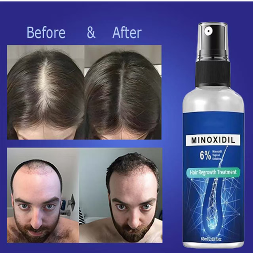 Order today and you will receive 2 bottles of Hair Nourishment and Hair Follicle Boosting Hair Spray. This spray activates hair follicles to promote new hair growth, repairs fine and weak hair strands, reduces hair loss, and cares for the scalp. It is suitable for both men and women. Persist for 2 months and witness a thickening transformation. Reclaim your hair volume and confidence. Restore your hair to its shining best!
