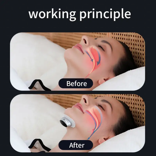 This intelligent electric anti-snoring device comes with 10 electrode pads. It uses TENS pulse technology and has an intelligent chip that automatically identifies snoring sounds to adjust the mode. It is comfortable to wear. It effectively alleviates snoring and enables you and your family to have a good night's sleep. It is the sleep-saving hero for those troubled by snoring.