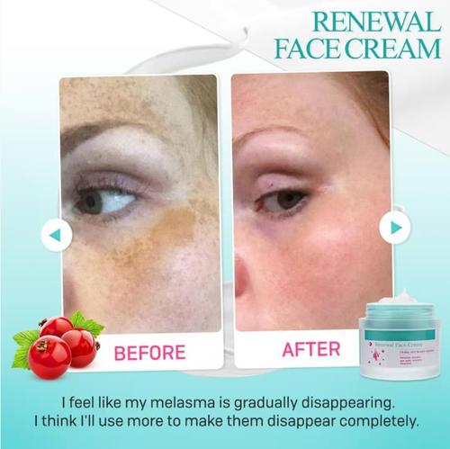 Order today and you will receive 3 boxes of Sam's identical anti-dark-spot, brightening, moisturizing and hydrating facial cream. Your skin will regain its vitality within 14 days. It gently reduces yellow and brown spots as well as freckles. The effect will become apparent in 2 - 3 weeks. Its texture is smooth and fine, which can tighten pores and reduce fine lines. It nourishes the skin and gives it a smooth and flawless appearance.