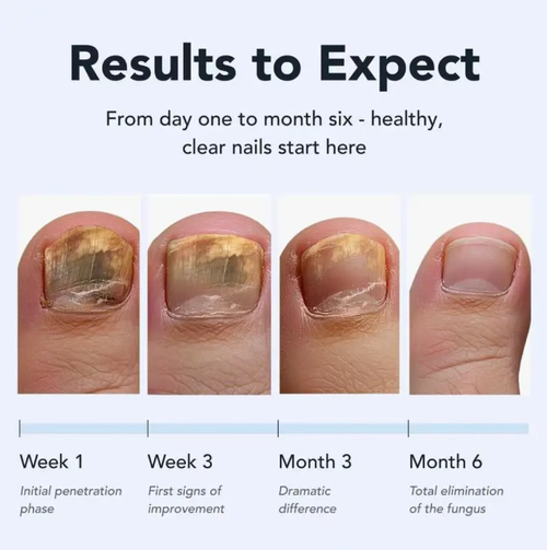 If you place an order today, you will receive 6 units, which is a complete course of treatment. The anti-fungal care pen contains 25% undecenoic acid and precisely penetrates to inhibit fungi. The pen-shaped design is portable and leak-proof, gentle and non-irritating. It can improve chapped feet and athlete's foot. A 2-minute daily care is all you need!