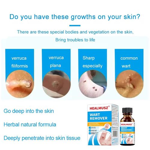 Suitable for various skin warts, Patent formula Ketrodil solution, featuring natural plant extracts, specifically targets flat warts, wart-like growths, and flesh-like horn-like warts. It penetrates deep into the wart base, reducing hyperplasia and improving the skin texture, with a gentle and non-irritating effect. Order today and get 3 bottles, Eliminate warts on the face, hands, and private areas completely, avoiding laser freezing. Enjoy smooth skin at home.