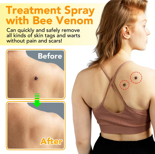 SEFUDUN Bee Venom Anti-Groin Spray, featuring a natural plant extract formula that gently blocks the nutrients of the growths, causing them to fall off painlessly and without leaving any marks. The spray is designed for convenience and precision, effectively repairing skin blemishes. Even sensitive skin can use it with peace of mind.