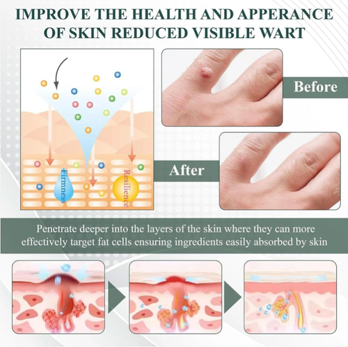 Place your order today and you will receive 3 large bottles of natural gel for removing warts, removing moles and fading spots: avocado + herbal essences. Apply it gently for 2-3 weeks, and the warts will dry up and fall off, while the mole spots will fade to the point of being invisible. Even sensitive skin can use it! Stock up on enough to clear all warts .moles. spots, and feel more confident when showing your natural face. The stock is in high demand, so hurry up and grab it!