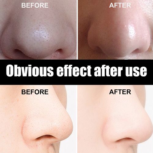 Blackhead Clearing Nose Strips | Peel & Reveal Visible Cleanliness