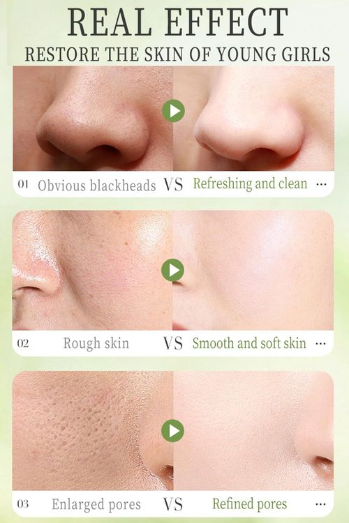 Multi-Acid Avocado Bubble Mask | Gentle Exfoliating & Purifying Clay Mask with Self-Foaming Action for Clear, Smooth Skin