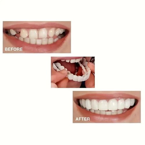 ComfortFlex White Dentures with Veneers