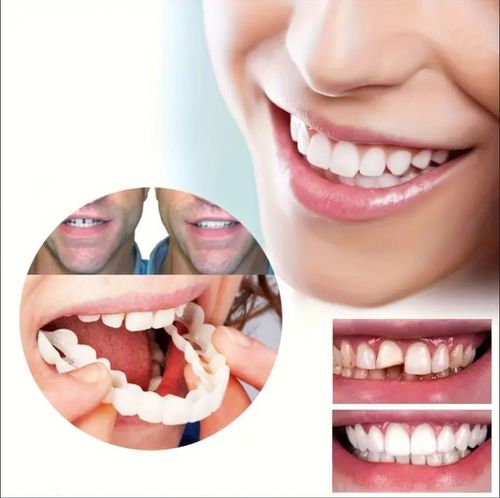 ComfortFlex White Dentures with Veneers