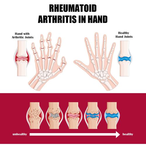 Joint & Bone Therapy Cream,  Intensive Joint & Bone Therapy Cream, Intensive Concentrate for Joint and Muscle Recovery, Provides Relief for Back, Neck, Hands, Feet (White, 30gm Each)