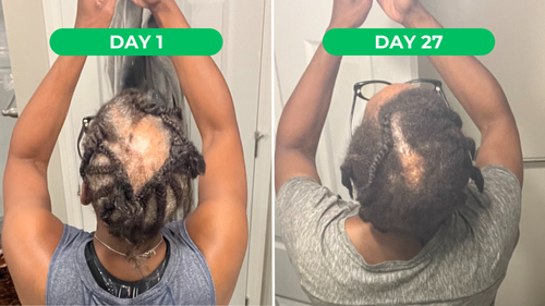 IMAGINE A VIDA SEM CALVÍCIES, BORDAS INVISÍVEIS, CABELOS RALOS E CABELOS ESTAGNADOS...