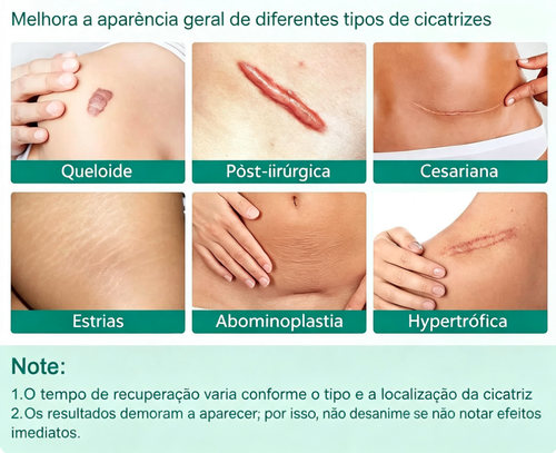 Folhas de silicone premium para cicatrizes, tamanho 1, rolo de 3 metros. Reutilizáveis, eficazes para a remoção de cicatrizes cirúrgicas, queloides, cesarianas e abdominoplastias. Não irritantes, flexíveis, respiráveis e confortáveis no tratamento de cicatrizes.