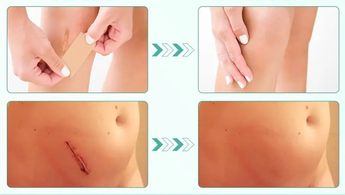 Folhas de silicone premium para cicatrizes, tamanho 1, rolo de 3 metros. Reutilizáveis, eficazes para a remoção de cicatrizes cirúrgicas, queloides, cesarianas e abdominoplastias. Não irritantes, flexíveis, respiráveis e confortáveis no tratamento de cicatrizes.