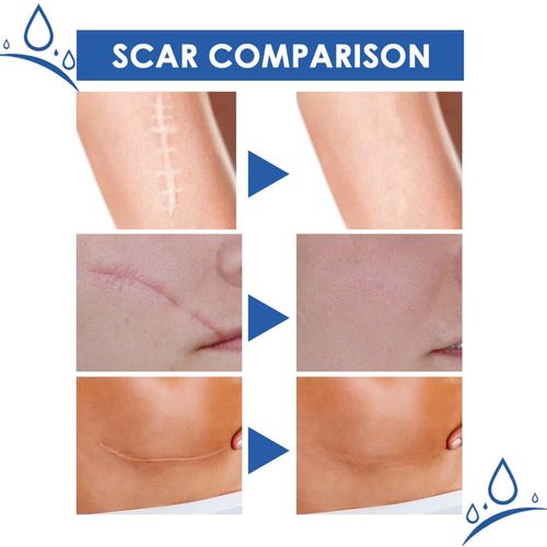 Scar Removal Cream Order today｜Buy 1 Get 2 FREE! Total 3 tubes