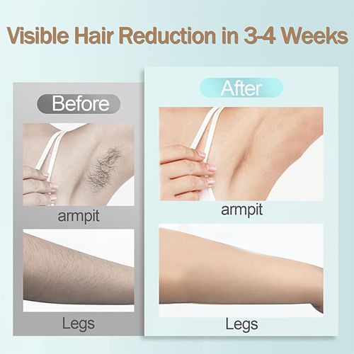 IPL hair removal device