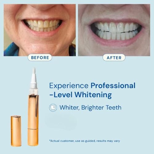 Peroxide Gel Tooth Cleaning Bleaching Kit Dental White Teeth Whitening Gel Pen