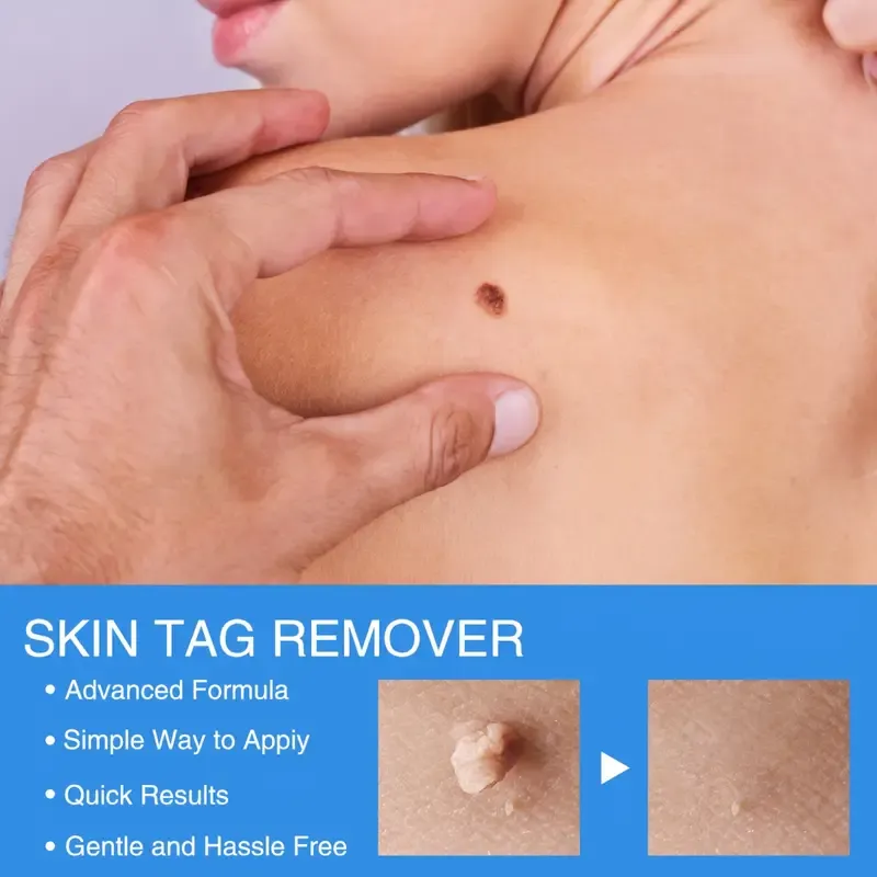 Removal Mole Kit Tools
