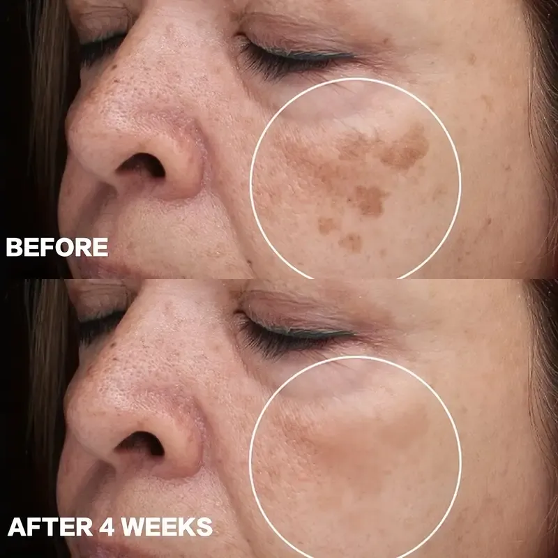 Hyperpigmentation Facial Cream