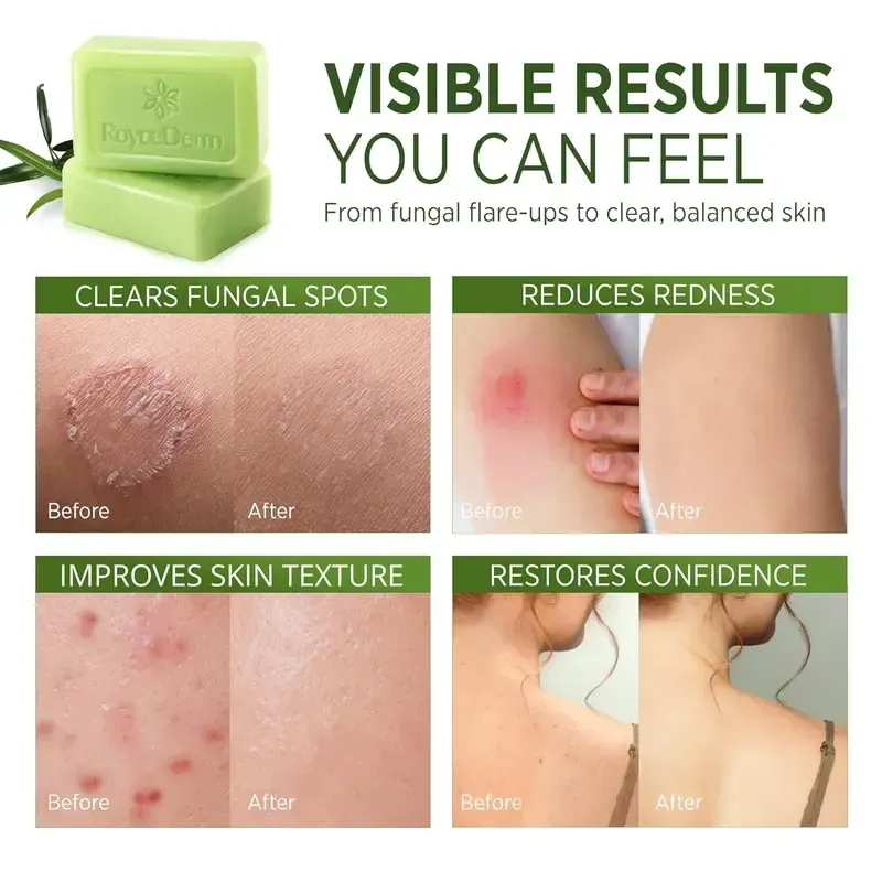 Tea Tree Soap: Antifungal Antibacterial Treatment for Face & Body Acne, Athlete's Foot, Tinea, Folliculitis, Ringworm, and Jock Itch