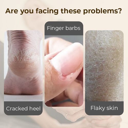 ✨ZXB-CePin🔥 60% Urea Foot Cream – Soften Cracked Heels and Rough Soles, Roll-On No Mess⚡1021