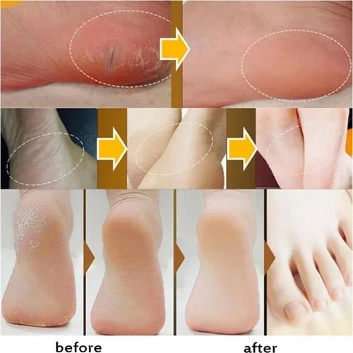 3PCS Beauty Product Herbal Anti Crack Foot Cream Heel Cracking Repair Products Exfoliation Dead Skin Removal Softening Moisturize
