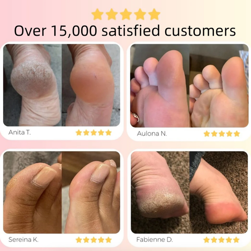Electric Callus Remover