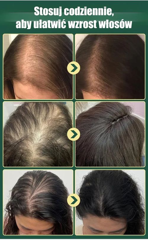 Shampoo with herbal extract – The less hair you have, the better the effect.