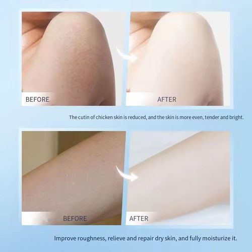 Vitamin E urea cream! Vitamin E + urea dual effect, precisely removes black melanin and spots on face and body, even darkening around elbows and knees can be eliminated. Smooth and easily absorbed, not sticky. Order today and get 5 bottles directly. Dryness + dullness + spots all solved at once. For those who are slow to recover, the price per bottle is lower. Hurry up and order!