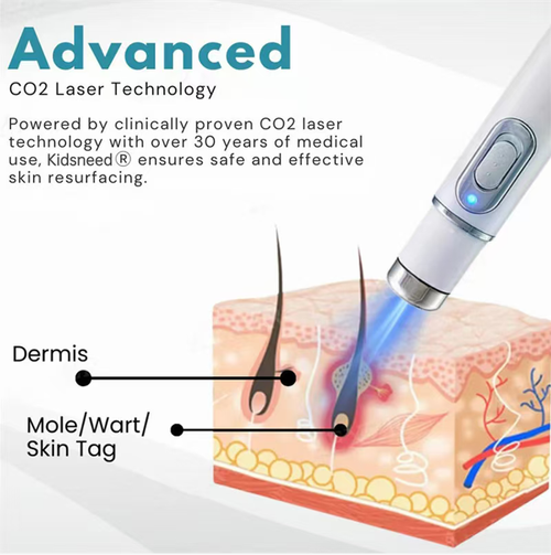 The ultrasonic laser wart removal pen is equipped with 30 years of clinical carbon dioxide laser technology. It can precisely remove moles, warts and skin blemishes, and alleviate the symptoms of rosacea within one week. The pen is small and portable, and can be operated with just one button. It enables you to easily handle various skin blemishes at home, and is gentle and non-irritating to the skin.